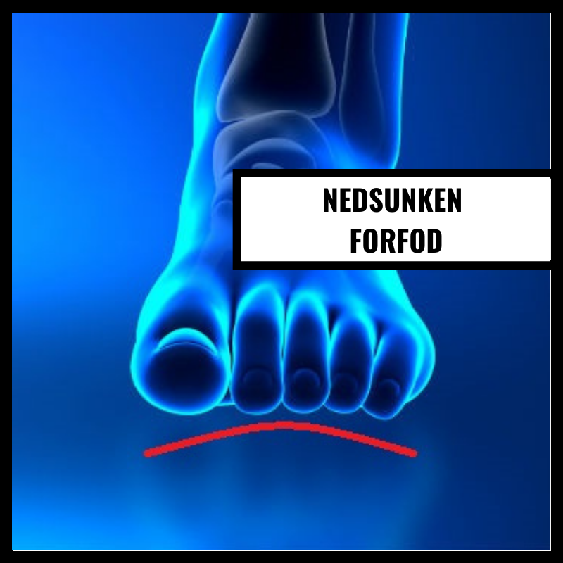 Nedsjunken framfot
