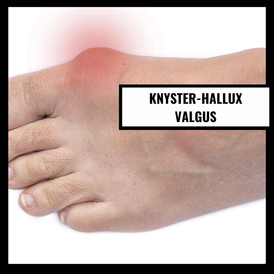 Knölar - Hallux Valgus